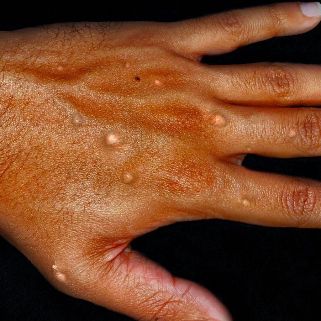 Що варто знати про вірус MPOX (віспу мавп) в Україні: як передається і які симптоми